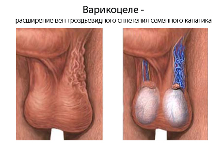 Фотография к новости Болезни половых органов у мужчин