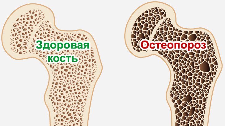Фотография к новости Причины развития остеопороза